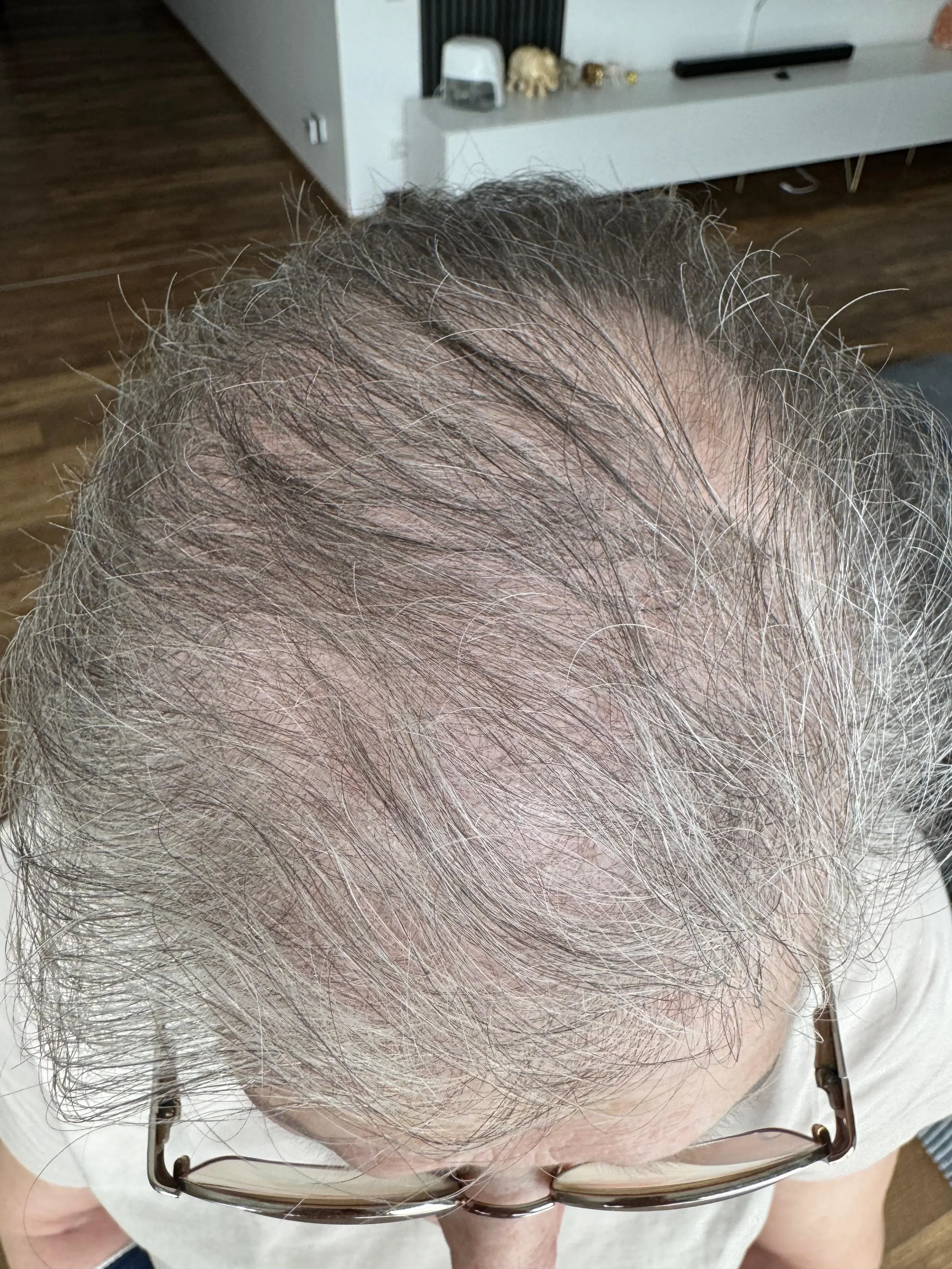 Haarwachstum 1 Nachher