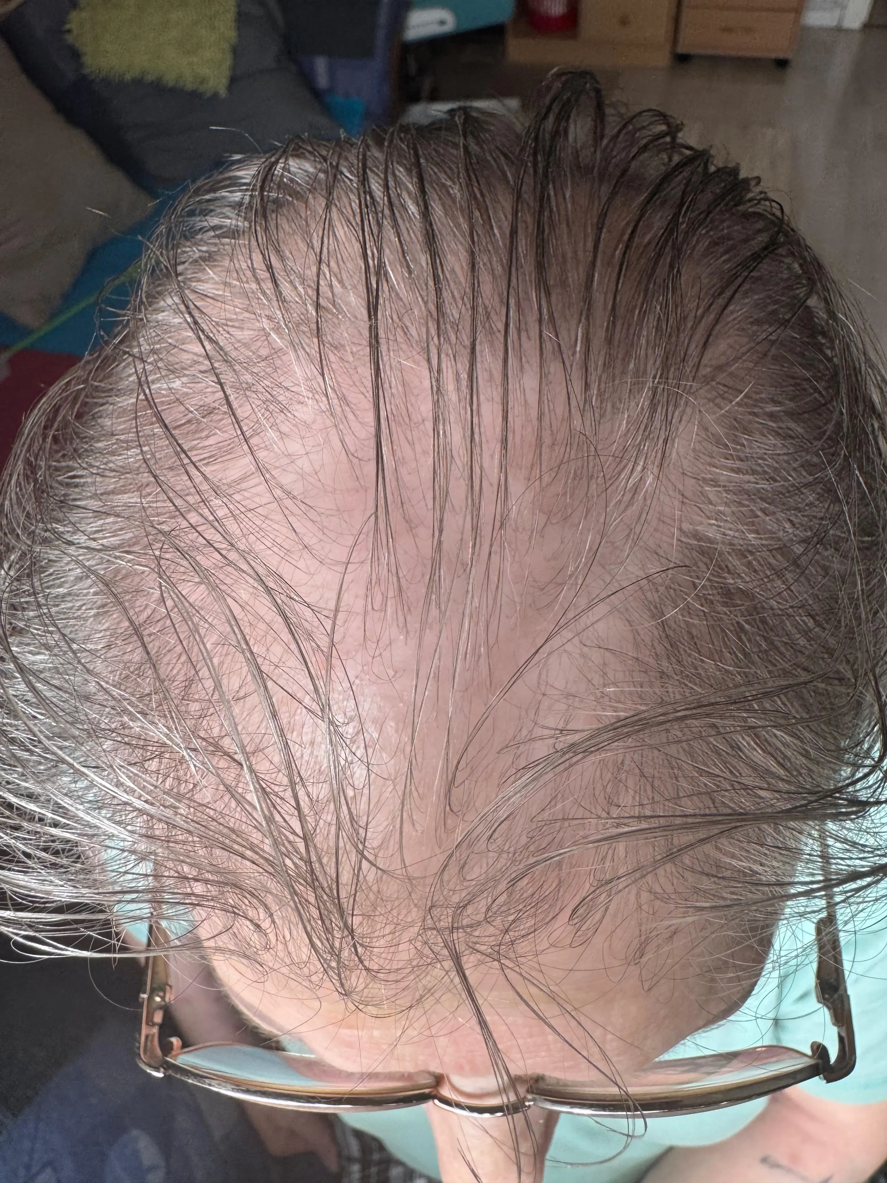 Haarwachstum 1 Vorher