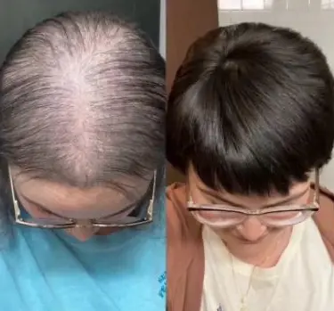 Haarwachstum 20 Vorher Nachher